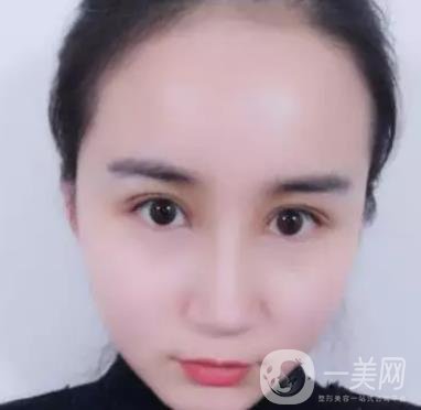 長海醫(yī)院邢新做雙眼皮修復好嗎？價格表及案例詳情一覽