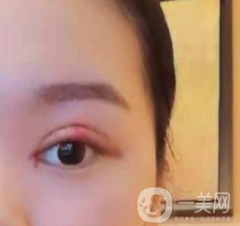 河北省人民醫(yī)院做雙眼皮咋樣?價格表一覽