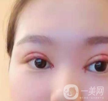 河北省人民醫(yī)院做雙眼皮咋樣?價格表一覽