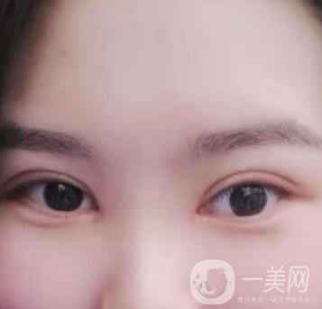 河北省人民醫(yī)院做雙眼皮咋樣?價格表一覽