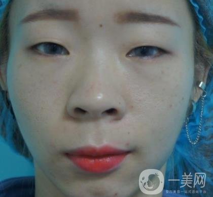 北京彤美醫(yī)療整形醫(yī)院價(jià)格表，附桂行軍雙眼皮術(shù)后*果一覽