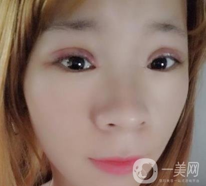 北京彤美醫(yī)療整形醫(yī)院價(jià)格表，附桂行軍雙眼皮術(shù)后*果一覽