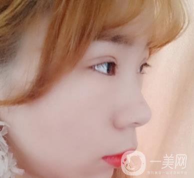 北京彤美醫(yī)療整形醫(yī)院價(jià)格表，附桂行軍雙眼皮術(shù)后*果一覽