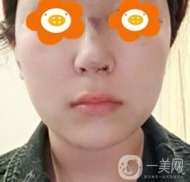 長沙貝美醫(yī)院做鼻子怎么樣?一覽價格表費用詳情