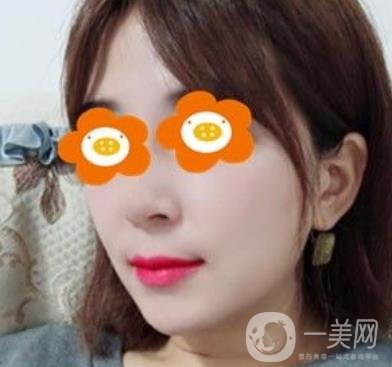 長沙貝美醫(yī)院做鼻子怎么樣?一覽價格表費用詳情