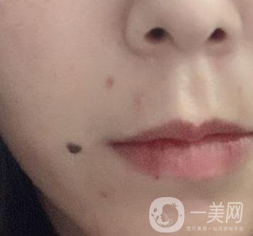 重慶附一院整形科價(jià)格表2020年公布，附祛痣整形日記