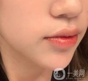 重慶附一院整形科價(jià)格表2020年公布，附祛痣整形日記