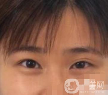 北京韓勛雙眼皮修復怎么樣？附整形價格表一覽