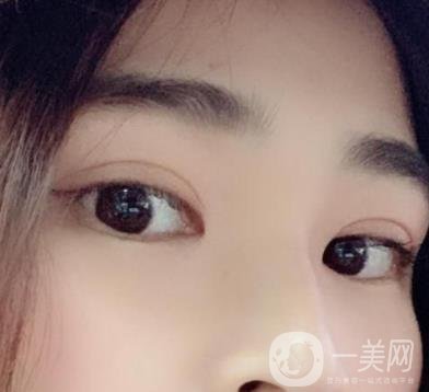 北京韓勛雙眼皮修復怎么樣？附整形價格表一覽