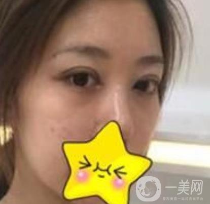 濟寧附屬醫(yī)院做雙眼皮多少錢？附真實案例及整形價格表