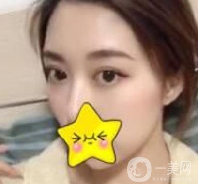 濟寧附屬醫(yī)院做雙眼皮多少錢？附真實案例及整形價格表