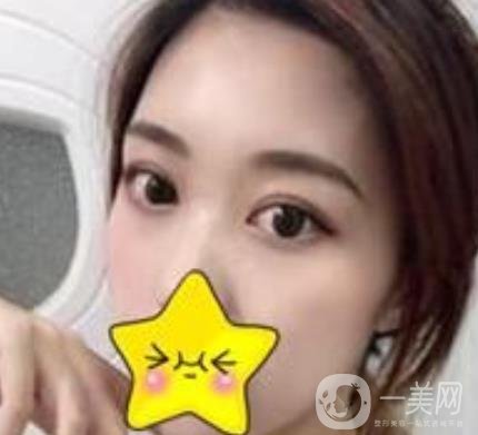 濟寧附屬醫(yī)院做雙眼皮多少錢？附真實案例及整形價格表