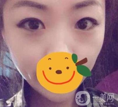 昆明市第一人民醫(yī)院雙眼皮多少錢？附案例及2020全新整形價(jià)格表