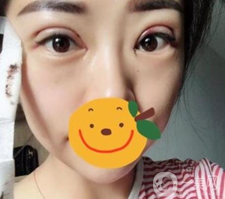 昆明市第一人民醫(yī)院雙眼皮多少錢？附案例及2020全新整形價(jià)格表