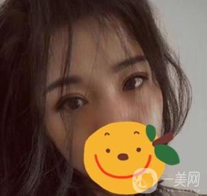 昆明市第一人民醫(yī)院雙眼皮多少錢？附案例及2020全新整形價(jià)格表