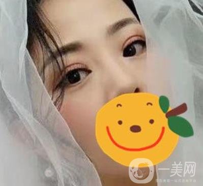 昆明市第一人民醫(yī)院雙眼皮多少錢？附案例及2020全新整形價(jià)格表