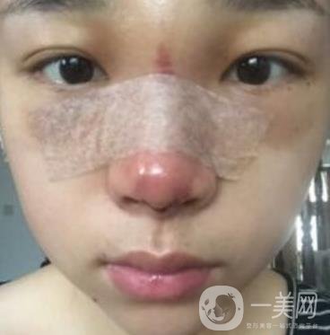 上海王輝醫(yī)生隆鼻