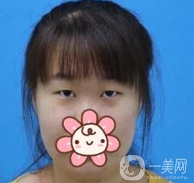 上海華美楊亞益做眼睛多少錢？?jī)r(jià)格表及案例詳情