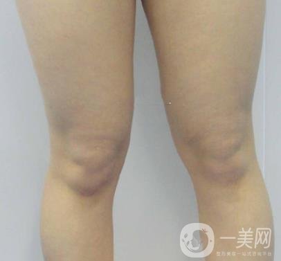 中南大學第一醫(yī)院整形美容科價格表*新發(fā)布,附全身吸脂*果分享