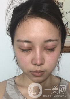 蘭大二院整形外科價(jià)格表2020，附雙眼皮整形日記