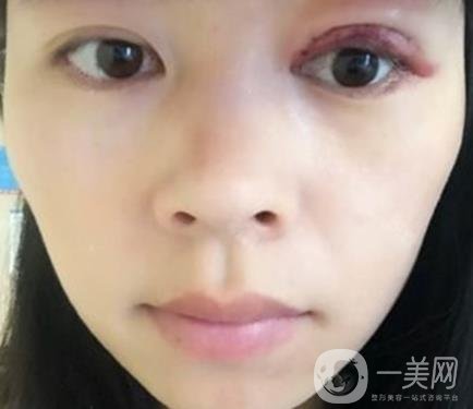 河南省立眼科醫(yī)院做上臉下垂怎么樣?價(jià)格表和真人*果圖展示