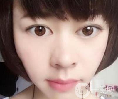 河南省立眼科醫(yī)院做上臉下垂怎么樣?價(jià)格表和真人*果圖展示