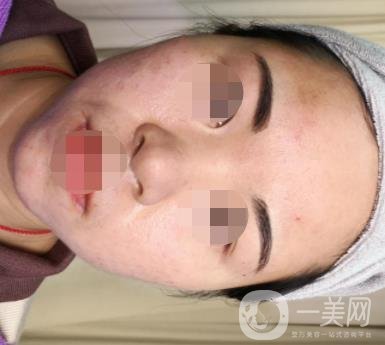 北京醫(yī)院整形科繡眉*果怎么樣?2020年價(jià)格表日常收費(fèi)詳情一覽