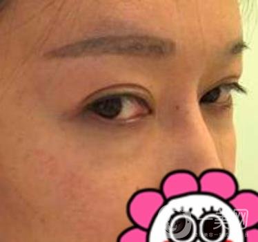 北京友誼醫(yī)院整形科祛眼袋*果好不好？2020年價格價目收費曝光啦