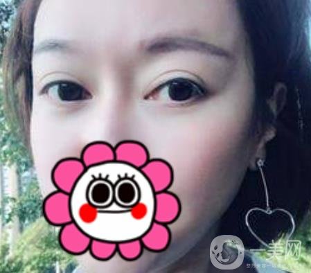 北京友誼醫(yī)院整形科祛眼袋*果好不好？2020年價格價目收費曝光啦