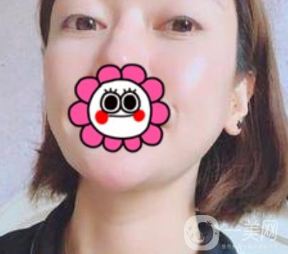 北京友誼醫(yī)院整形科祛眼袋*果好不好？2020年價格價目收費曝光啦