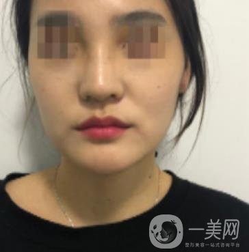 深圳人民醫(yī)院整形外科價(jià)目表，附隆鼻案例