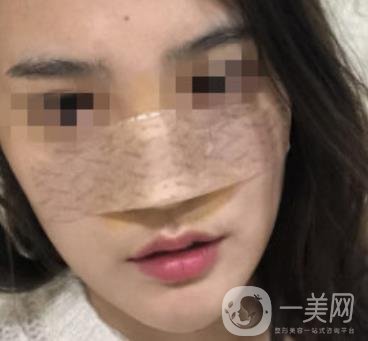 深圳人民醫(yī)院整形外科價(jià)目表，附隆鼻案例