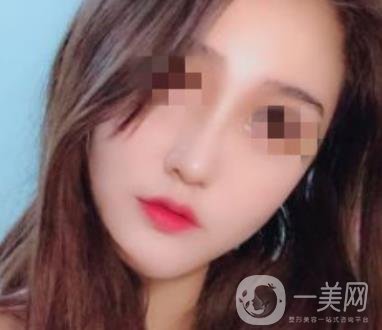 深圳人民醫(yī)院整形外科價(jià)目表，附隆鼻案例