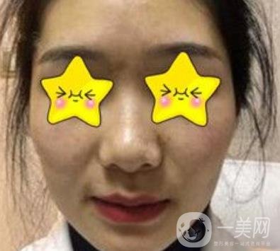 深圳北大醫(yī)院自體脂肪填充