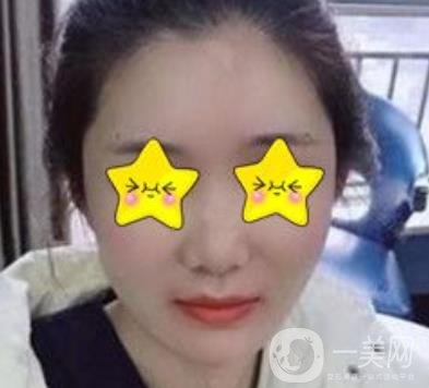 深圳北大醫(yī)院自體脂肪填充