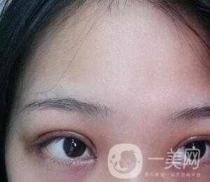 上海華美醫(yī)療美容醫(yī)院價格表，附雙眼皮修復(fù)案例