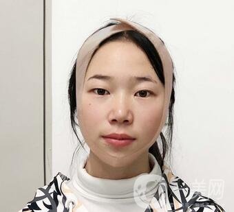 西安高一生醫(yī)療美容醫(yī)院價格表，附面部吸脂案例分享