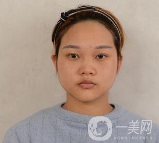 成都銅雀臺整形醫(yī)院隆鼻案例分享，附全新價格表