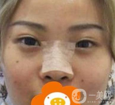 蚌埠美萊塢整形醫(yī)院玻尿酸隆鼻*果如何？價(jià)格表2020年收費(fèi)公布