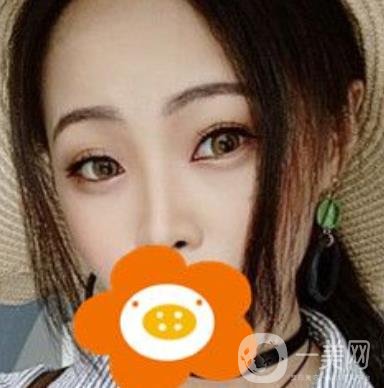 蚌埠美萊塢整形醫(yī)院玻尿酸隆鼻*果如何？價(jià)格表2020年收費(fèi)公布