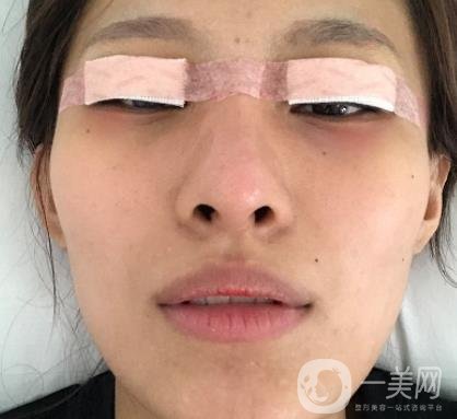 大連市中心醫(yī)院雙眼皮怎么樣？費用是多少？真人恢復(fù)經(jīng)歷自述