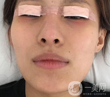 大連市中心醫(yī)院雙眼皮怎么樣？費用是多少？真人恢復(fù)經(jīng)歷自述