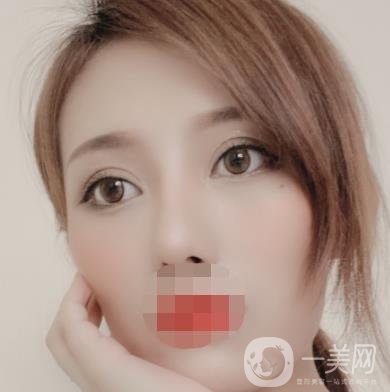 大連市中心醫(yī)院雙眼皮怎么樣？費用是多少？真人恢復(fù)經(jīng)歷自述