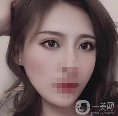 大連市中心醫(yī)院雙眼皮怎么樣？費用是多少？真人恢復(fù)經(jīng)歷自述