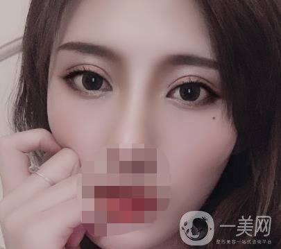 大連市中心醫(yī)院雙眼皮怎么樣？費用是多少？真人恢復(fù)經(jīng)歷自述