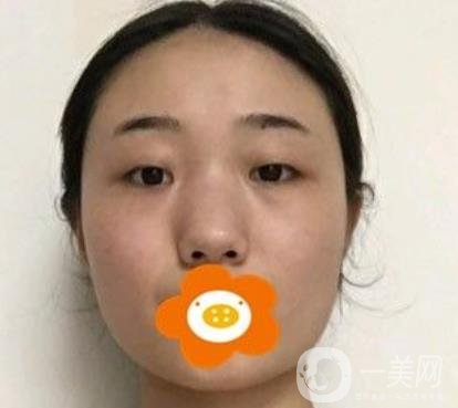南京美貝爾整形醫(yī)院做*好不好？?jī)r(jià)格表費(fèi)用明細(xì)和*果圖參考