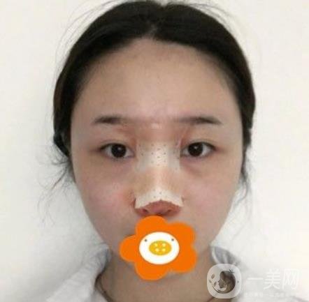 南京美貝爾整形醫(yī)院做*好不好？?jī)r(jià)格表費(fèi)用明細(xì)和*果圖參考