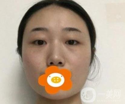 南京美貝爾整形醫(yī)院做*好不好？?jī)r(jià)格表費(fèi)用明細(xì)和*果圖參考