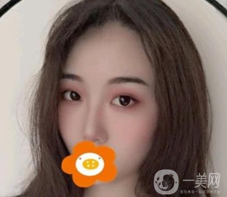 南京美貝爾整形醫(yī)院做*好不好？?jī)r(jià)格表費(fèi)用明細(xì)和*果圖參考