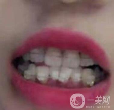 廣東省口腔醫(yī)院正畸價格表及案例恢復過程分享